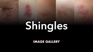 Shingles Herpes Zoster Image Gallery [upl. by Dowell]