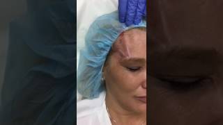 Non Invasive Brow Lift  Done with PDO Threads [upl. by Puiia657]