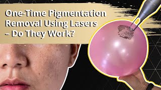 Debunking Myths About OneTime Pigmentation Treatment Using Lasers [upl. by Goodwin]