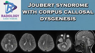 Joubert syndrome with corpus callosal dysgenesis [upl. by Otnicaj]