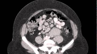 CT Abdomen Lymphadenopathy DISCUSSIONmp4 [upl. by Durham]