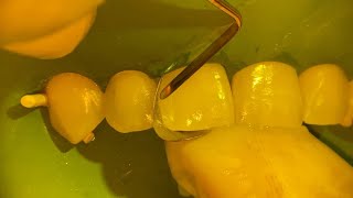 FAST amp EASY way to close a tooth gap with composite [upl. by Jotham]