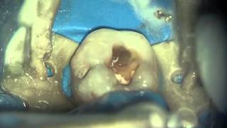 Cavity Preparation  Tooth 47 by Grzegorz Witkowski [upl. by Alraep]