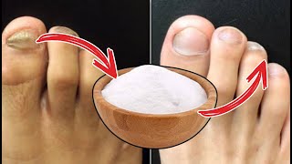 URGENT MIX THIS AND GOODBYE FUNGI ON NAILS Foot Fungus Natural Treatment [upl. by Timoteo]