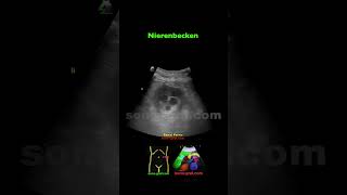 Sonographie  Nierenaufstau Zweiten Grades [upl. by Nedyarb473]