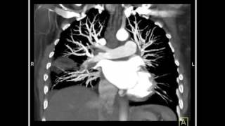 Lung Anatomy Pulmonary Emboli amp Infarcts VRT 3 of 4 [upl. by Nesyrb]