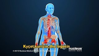 OSTEOPOROZA  SËMUNDJA E ESHTRAVE ANIMACION 3D [upl. by Ennazus794]