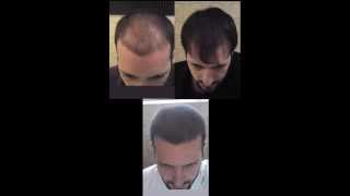 Time Lapse  18 months of hair loss treatment [upl. by Henley]