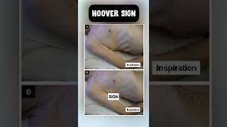 Hoover sign in copd usmle neetpg pulmonology [upl. by Mccandless773]