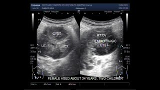 Two Cases of Hemorrhagic ovarian cysts [upl. by Eceeryt]