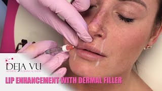 Lip Enhancement with Dermal Fillers  Deja Vu Aesthetic Training Academy Bristol amp South West [upl. by Bear]