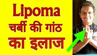 Acupressure Points For LIPOMA  Single Acupressure Point For Lipoma REMOVAL  In Hindi [upl. by Prosperus]