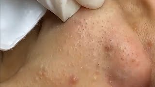 SATISFYING NOSE BLACKHEADS REMOVAL 65 [upl. by Nivrad]