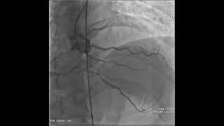 Coronary angiography showing left main coronary artery dissection [upl. by Holli219]