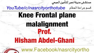 Knee frontal malalignmentProfHisham Abdelghani Nasrcity online lectures 2020 [upl. by Sinnoda]