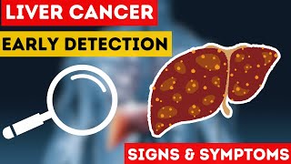 Liver Cancer Uncovering Causes Symptoms amp Early Detection [upl. by Hnib139]