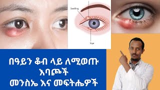 በዓይን ቆብ ላይ የሚወጡ እብጠቶች መንስኤዎች እና መፍትሔዎች Causes and management options of eyelid swelling [upl. by Refitsirhc311]