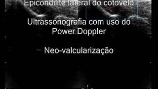 Ultrassom do cotovelo  Epicondilite lateral com fluxo ao Doppler [upl. by Herby]