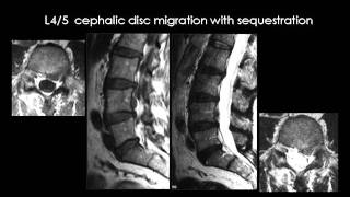 Radiology  Spinal Degenerative disease [upl. by Cathleen]