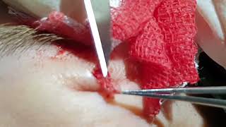 removing intradermal nevus [upl. by Atnoid300]