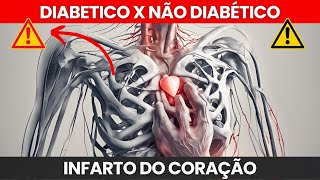 DOR DO INFARTO EM DIABÉTICOS E NÃO DIABÉTICOS [upl. by Ailuig]