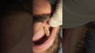 Impacted third molar extraction [upl. by Aicital]