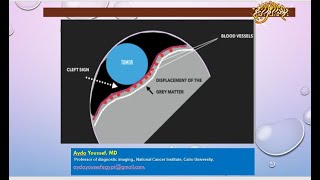 extra axial lesions [upl. by Nirol788]