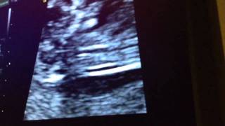 12 Week Ultrasound  Its a BOY [upl. by Pepi]