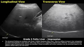 Grade 2 Fatty Liver Ultrasound Report Example  Diffuse Hepatic Steatosis Sonography  Abdominal USG [upl. by Enalda905]