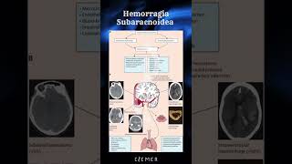 🧠 Fisiopatología de la Hemorragia Subaracnoidea 🧠 CIEMER FOAMed [upl. by Notsirt]