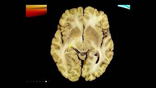 Neurology Exam Cranial nerves I and II [upl. by Aicatsue944]