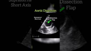 Aortic Dissection Type A echocardiography cardiology anatomy heart shorts [upl. by Atika]