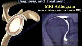 SLAP Tear Symptoms Diagnosis And Treatment  Everything You Need To Know  Dr Nabil Ebraheim [upl. by Aisirtap114]