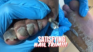 SATISFYING NAIL TRIM  SEVERE CRACKED HEELS [upl. by Rushing]