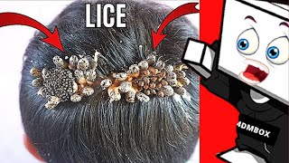 Worst Head Lice Infestation Ever [upl. by Miculek]