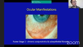 Dr Chang New Treatment Strategies for ocular cicatricial pemphigoid OCP [upl. by Zerla]