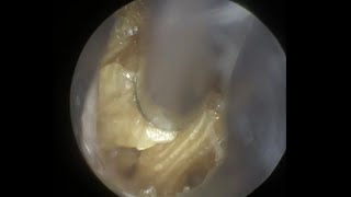 65  Possible Canal Cholesteatoma Revealed Post Ear Wax Removal with WAXscope®️ [upl. by Kironde]