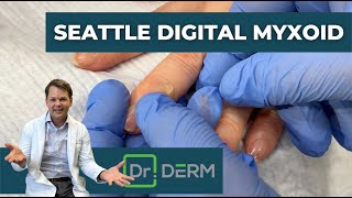 Digital Myxoid from Seattle  Dr Derm [upl. by Tichon]