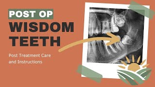 What Are the Rules After Wisdom Teeth Removal Post Treatment Care from Wisdom Teeth Extraction [upl. by Gottfried249]