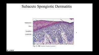 Spongiotic reaction patterns [upl. by Remington255]