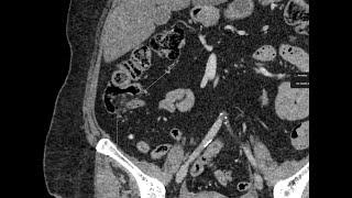 Lipomatosis of the ileocecal valve [upl. by Lala]