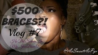 500 Braces Vlog 7  He Put Screws In My Jaw Bone [upl. by Anahsed889]