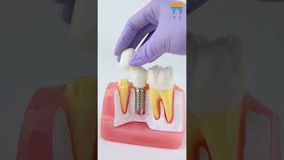 iDENTical Implant Analysis Model M2017  Essential Dental Education Tool shorts dentalkart [upl. by Annoek]