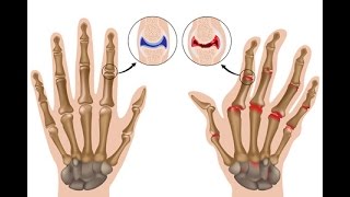 Rheumatoid Arthritis [upl. by Bouton]