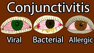 Pink Eye Conjunctivitis  Viral Bacterial and allergic conjunctivitis Symptoms and treatment [upl. by Sharyl]