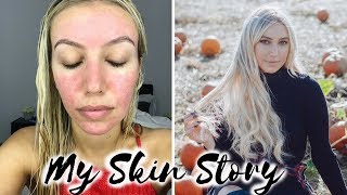 HOW I CURED MY ACNE ROSACEA BEFORE amp AFTER MY SKIN STORY REDNESS ACNE TREATMENT Scarlett London [upl. by Eldredge]