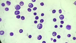 Anaemic changes  anisocytosis  microcytosis [upl. by Griffy520]