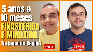 FINASTERIDA E MINOXIDIL 5 anos e 10 meses de Tratamento Capilar  Tiago Fontenele [upl. by Cain]