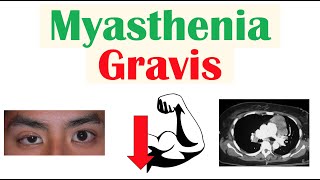 Myasthenia Gravis  Pathophysiology Signs amp Symptoms Diagnosis Treatment [upl. by Goeselt]