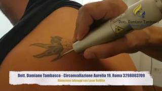 Rimozione tatuaggio Roma con laser Q SWITCHED REVLITE  Dott Tambasco [upl. by Medlin829]